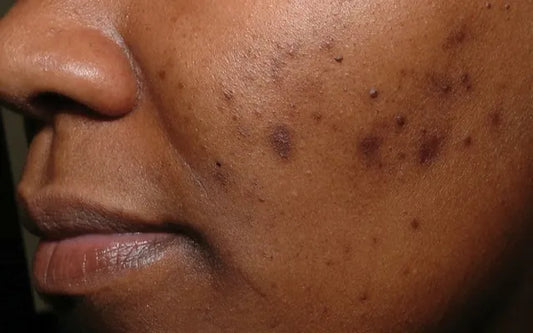 What to know about hyperpigmentation on dark skin - SENSEOFREASONS