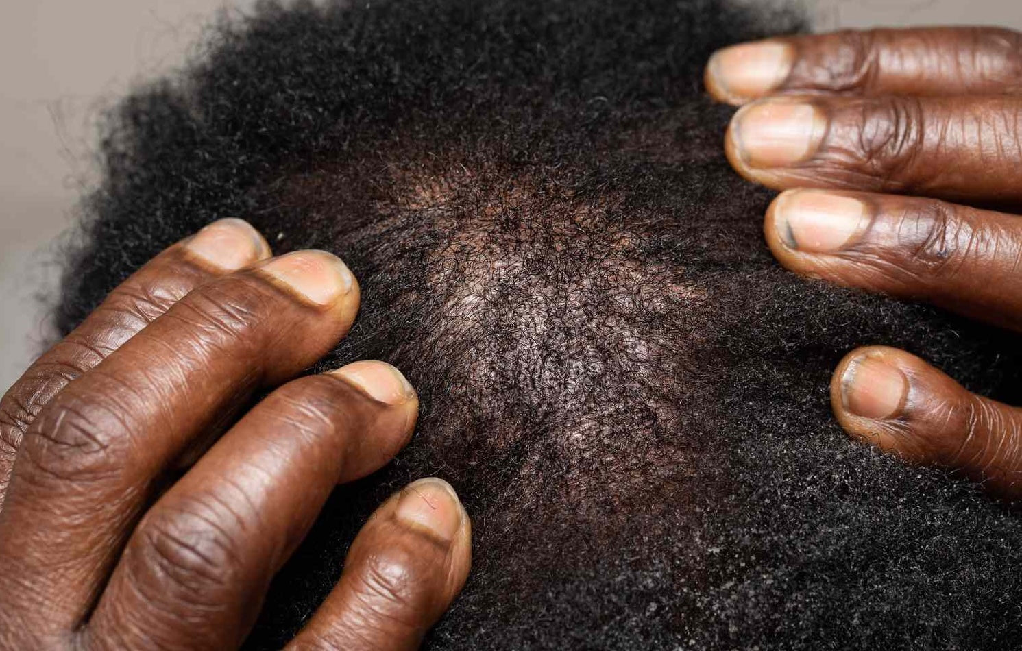 Why Your Afro Hair Is Thinning: DHT, Stress or Breakage? 