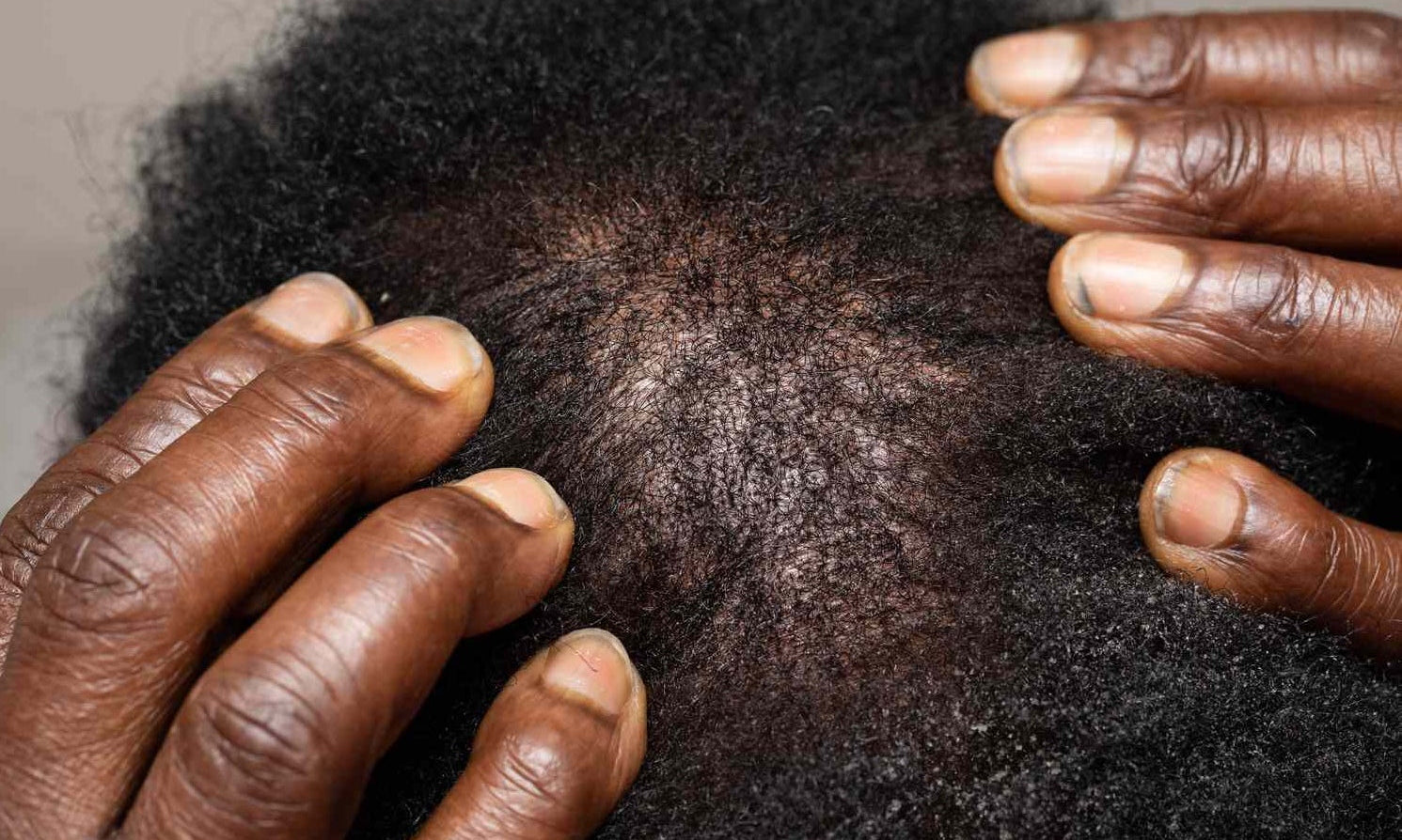  Why Your Afro Hair Is Thinning: DHT, Stress or Breakage? 