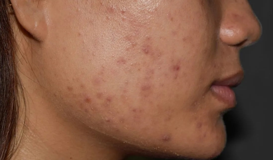 Post-Acne Dark Spots on Melanin Skin: Why They Keep Returning
